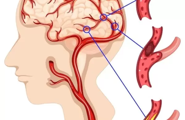 El infarto cerebral (ICTUS)